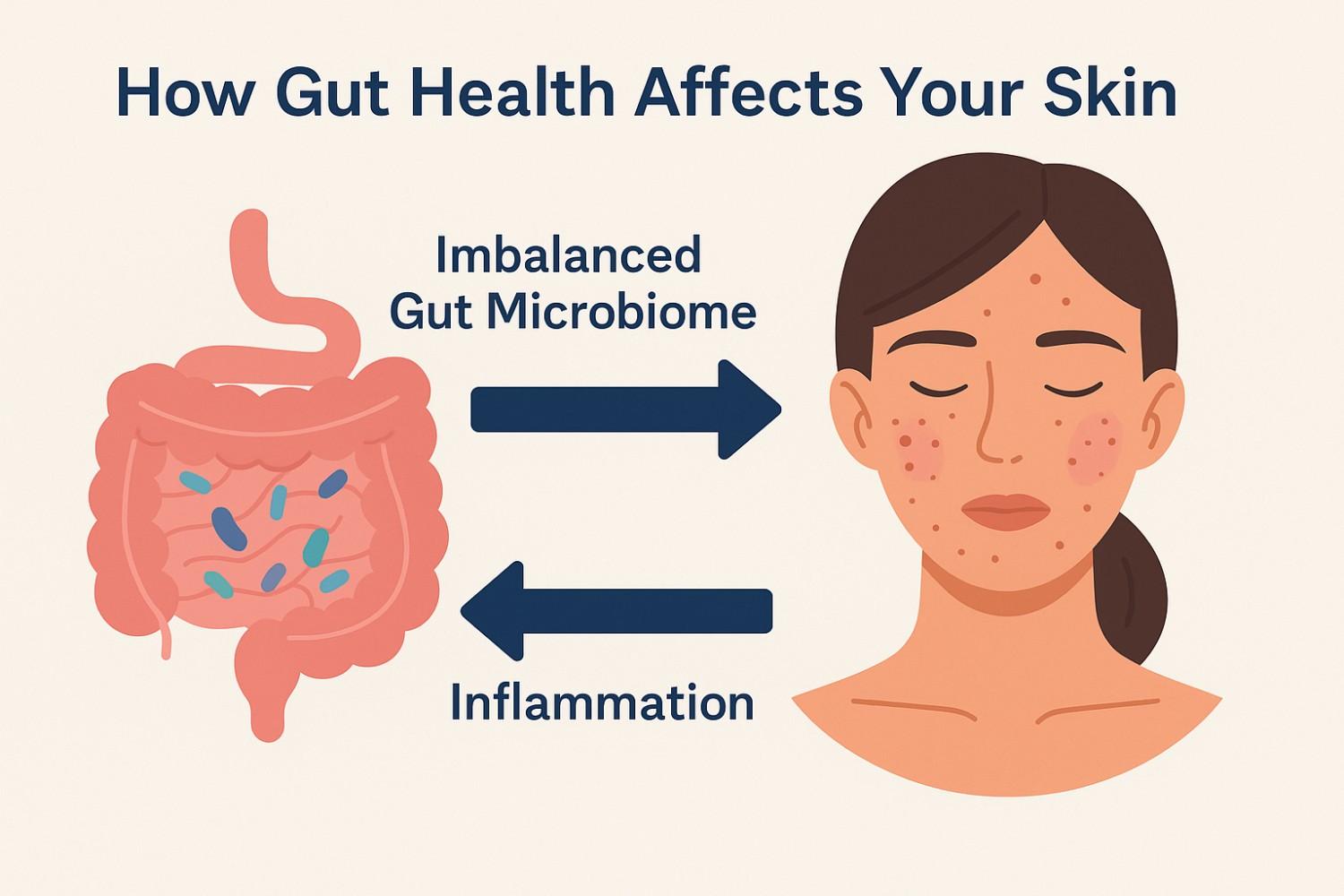 Infographic showing the gut-skin axis: a split image of a woman's face with acne on one side and healthy skin on the other, connected to a stylized digestive tract. Arrows highlight the link between gut microbiome imbalance, inflammation, and skin issues like redness or breakouts.