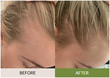 FullyVital user transformation with reduced shedding and new hair growth