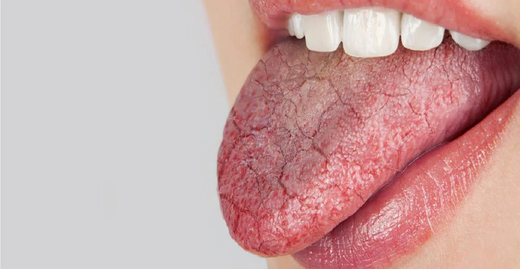Close-up of a dry, cracked tongue, showing symptoms of dry mouth (xerostomia).